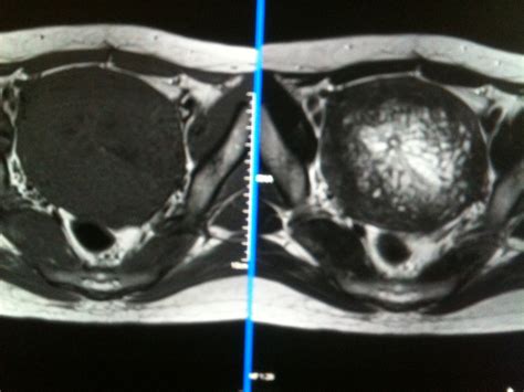 Endometrial Hyperplasia Versus Endometrial Cancer - Sumer's Radiology Blog