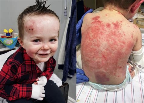 ‘His skin is as fragile as the wings of a butterfly’: Mom’s heartbreaking account of son’s rare ...