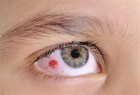 Subconjunctival Hemorrhage: Treatment, Causes, Symptoms, Newborn & Healing Time