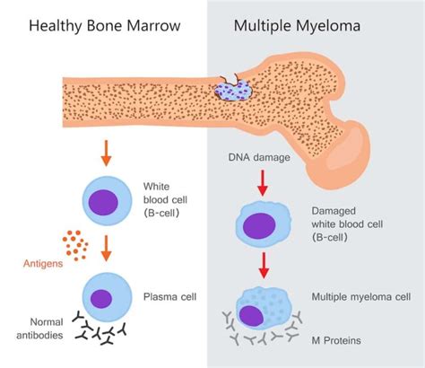 Multiple Myeloma: Signs and symptoms, Causes, Stages, Types, Diagnosis ...