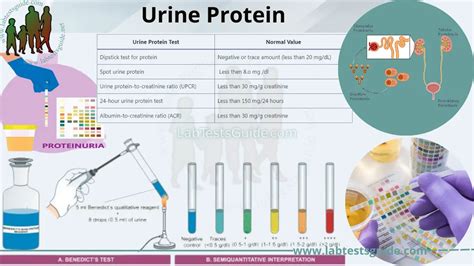 Protein Loss In Urine (Proteinuria) Symptoms, Causes And, 44% OFF