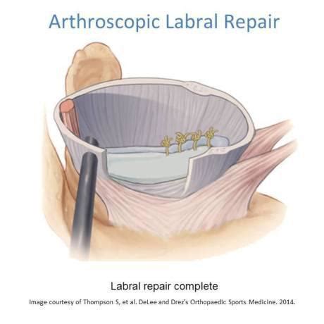 Shoulder Labral Tear- Labral Repair and Rehabilitation | Ashvin K Dewan, MD