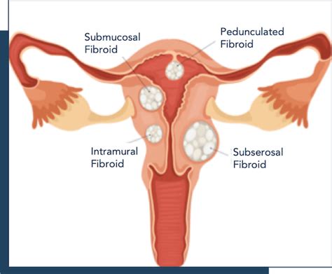 Pedunculated Fibroid: Symptoms, Pregnancy, Treatment