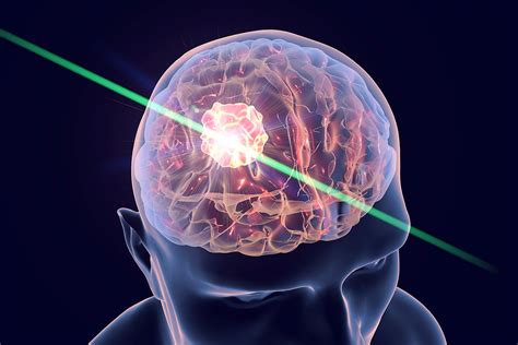 Lasers help fight deadly brain tumors – Washington University School of ...