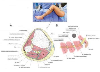 Common Peroneal Nerve Release at the Fibular Head | Surgical Education ...