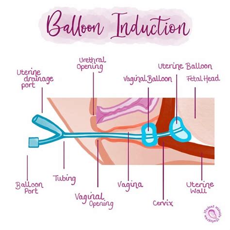 Balloon Catheter Induction Midwifery Student, Student Midwife, Nurse Midwife, Ob Nursing ...