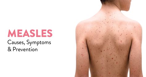 Measles: Causes, Symptoms, and Prevention - CK Birla Hospital