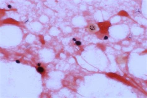 Gram stain: Gram positive budding yeast cells ( 100X. India Ink ...