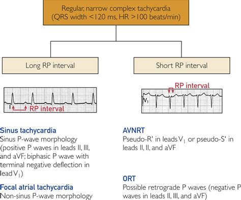 Paroxysmal Atrial Tachycardia Vs Sinus Tachycardia