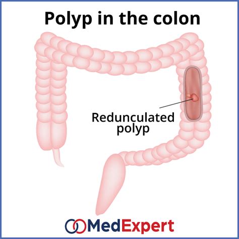 Colon polyps treatment, symptoms and diagnostics services | MED Expert