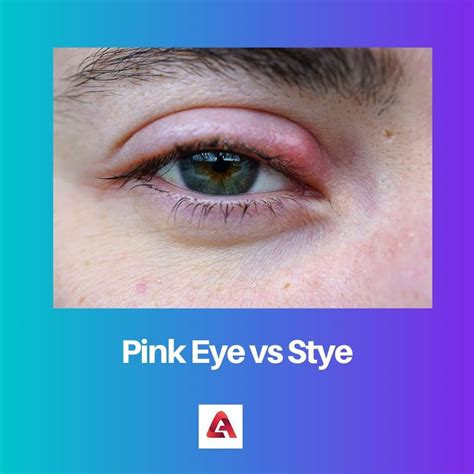 Pink Eye vs Stye: Difference and Comparison