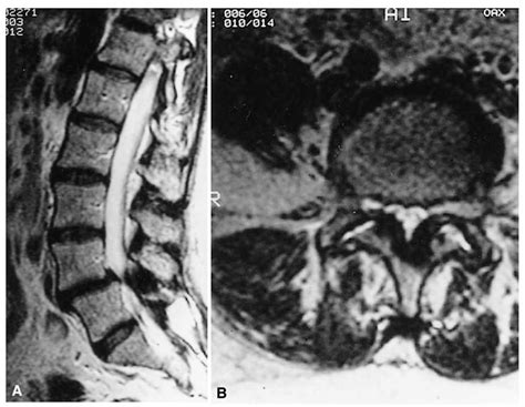 Approach to the Patient with Low Back Pain, Lumbosacral Radiculopathy, and Lumbar Stenosis ...