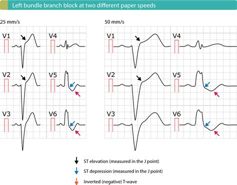 STEMI (ST Elevation Myocardial Infarction): diagnosis, criteria, ECG ...