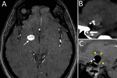 Brain Aneurysm Mri : 4 Intracranial Aneurysms Radiology Key - A brain aneurysm can result from a ...