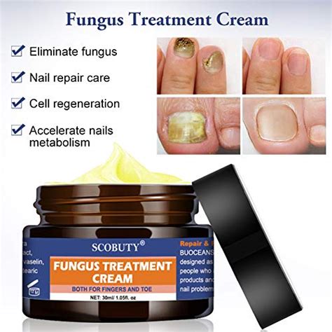 Fungus Cream, Nail Fungus Cream, Fungus Stop, Foot Fungus, Nail Repair, Restores the Healthy ...