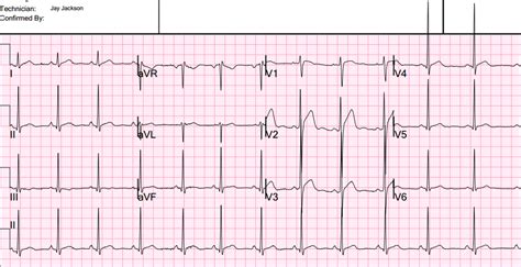 Dr. Smith's ECG Blog: 4 mm of ST elevation in lead V2 (at the J-point ...