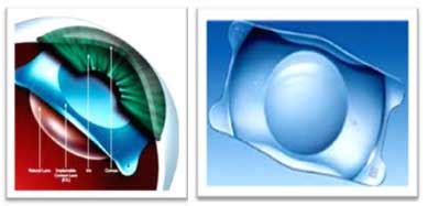 PHAKIC IOL SURGERY - Anil Eye Care Hospital