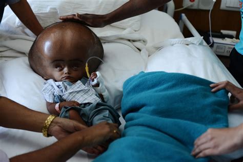 'Alien' baby suffers from a dangerously rare health condition that expands head to 27 inches in ...