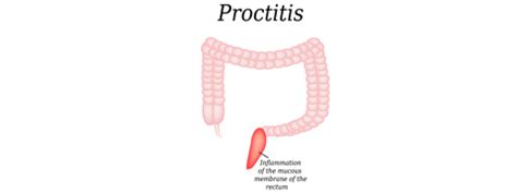 Proctitis Causes, Symptoms and Treatment