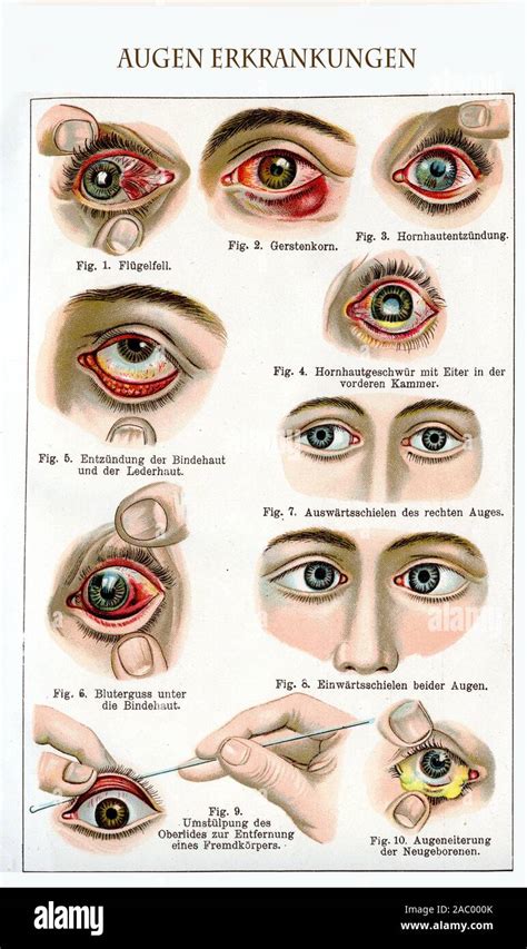 Eye Diseases