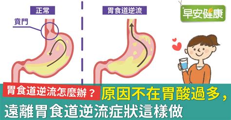 [問卦] 治胃食道逆流，到底該不該吃胃酸抑制劑？- 看板 Gossiping - Mo PTT 鄉公所