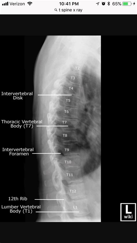 Lateral Thoracic Spine xray | Radiology imaging, Thoracic, X ray