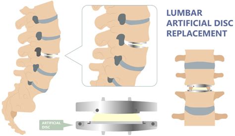 Artificial Disc Replacement for Cervical and Lumbar Spine - Minimally Invasive Neurosurgery of Texas