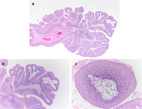 Histologic features of squamous papilloma. a The exophytic nature is... | Download Scientific ...