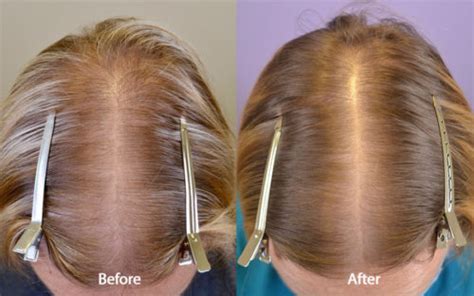 Spironolactone (For Females only) Before & After Photos - Hair ...