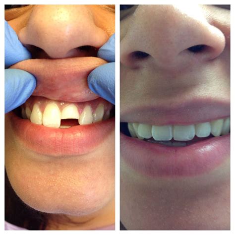 Before & After Photos of Treatments at Advanced Dental Care of NYC