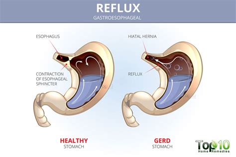 10 Foods You Shouldn't Eat if You Have Heartburn and Acid Reflux | Top 10 Home Remedies