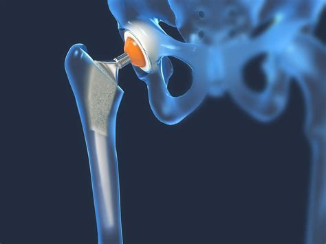 SuperPath vs. Anterior Hip Replacement: Which is Better?