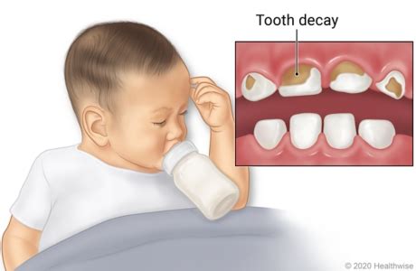 Baby Bottle Tooth Decay | Vaughan, Ontario | Dentistry 4 Kids and ...