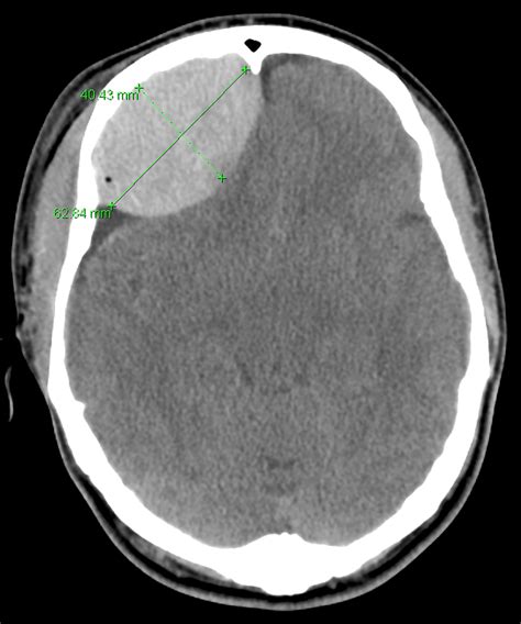 Epidural hematoma unequal pupil size - berlindop