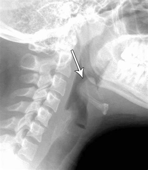 Epiglottitis – Core EM