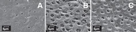 Scanning electron micrographs of sclerotic dentin (A - with no ...