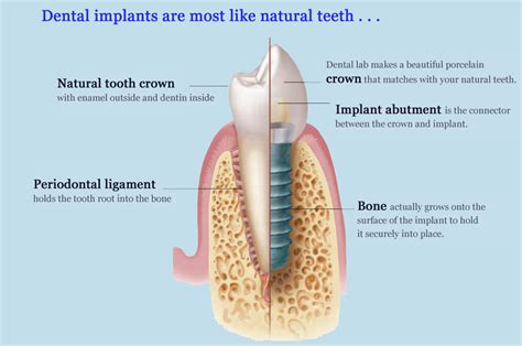 Dental Implant Procedure: New & Improved