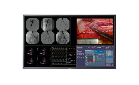 New large-screen 4K medical display for real-time imaging in the operating room - Barco