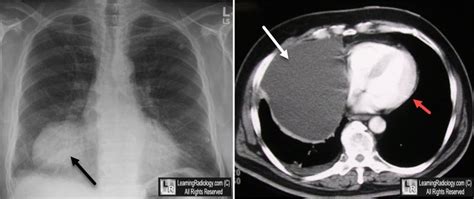 Learning Radiology - Pericardial Cyst