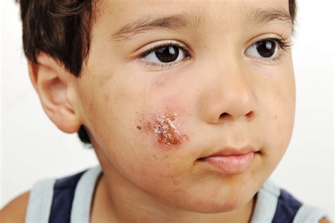 School sores- symptoms & treatment of impetigo - Qoctor your online doctor