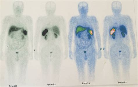 Figure3: Whole body octerotide scan: an octreotide avid lesion in the ...