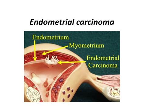 PPT - Endometrial carcinoma PowerPoint Presentation - ID:303808