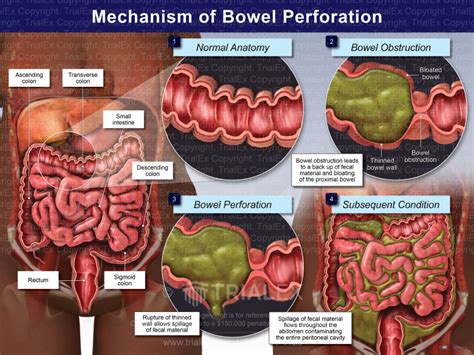 Mechanism of Bowel Perforation Heavy African American Female ...