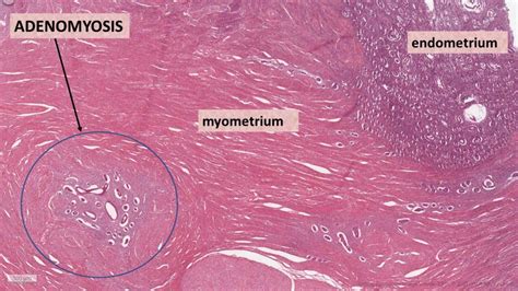 Pathology of Adenomyosis | Pathology Made Simple