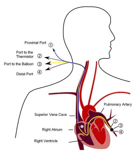 Pulmonary wedge pressure; Pulmonary Artery Wedge Pressure; Pulmonary ...