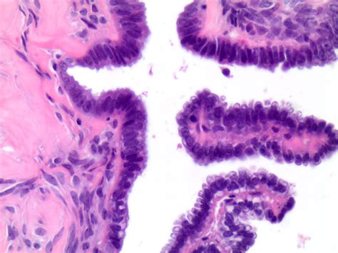 Serous Cystadenoma Histology