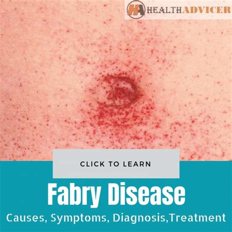 Fabry Disease: Causes, Picture, Symptoms, Diagnosis And Treatment