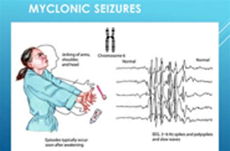 Myoclonic Seizure