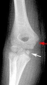 Pediatric Medial Epicondyle Fracture - A New Procedure For Fractures Of The Medial Epicondyle In ...