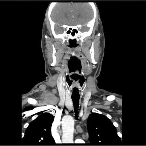 CT soft tissue neck with contrast (transverse view) highlighting large ...